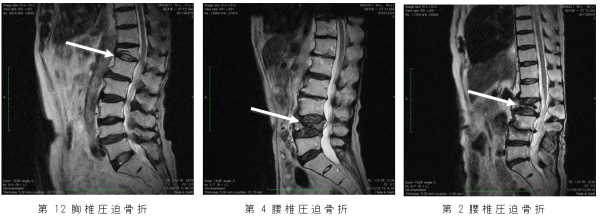 第 三 腰椎 圧迫 骨折